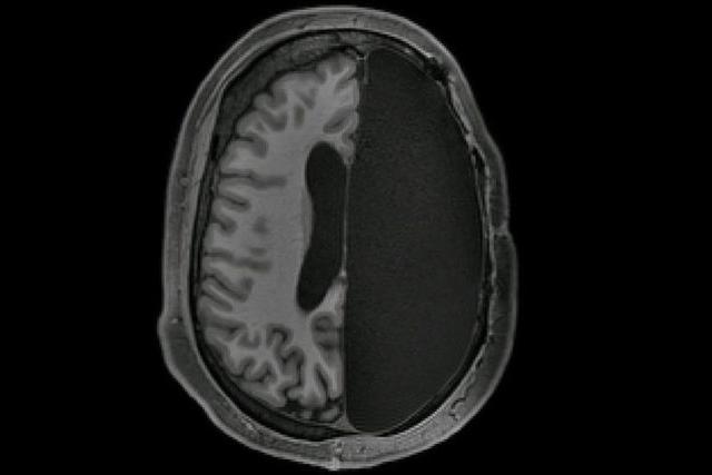 Половина мозга человека может функционировать ничуть не хуже целого: исследование 