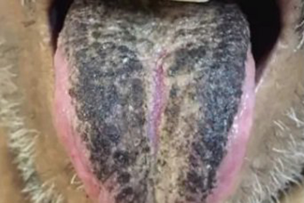 Редкий случай: у пациента язык покрылся плотным слоем черных волокон, напоминающим волосы