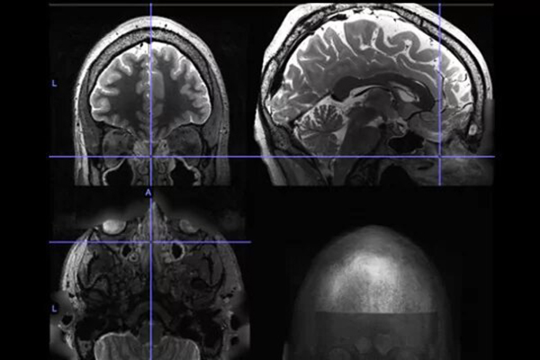 Насморк негативно отражается на работе нашего мозга: исследование 