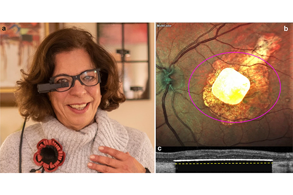 Медицина будущего: маленький имплант может вернуть зрение страдающим от глазного заболевания пациентам