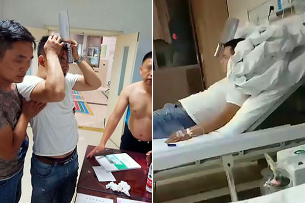 Китаец своими ногами пришел в больницу с застрявшим в черепе топориком для рубки мяса