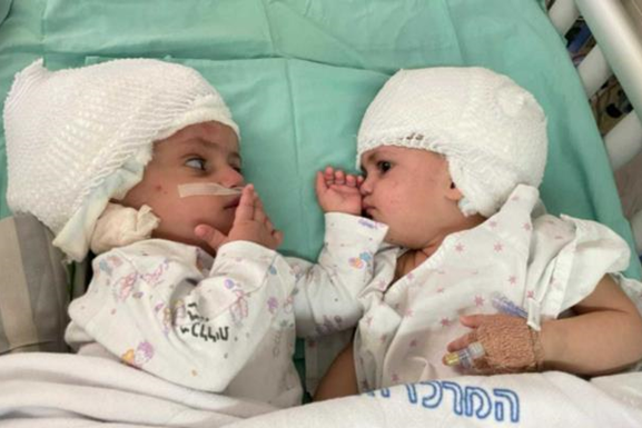 В Израиле провели первую в стране операцию по разделению годовалых сиамских близнецов, сросшихся головами