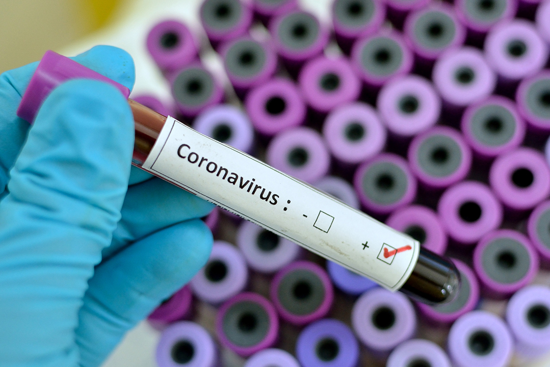 За минувшие сутки в Армении подтверждено 172 новых случая коронавируса, 171 человек выздоровел 
