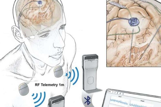Создано устройство, удаленно записывающее активность мозга в повседневной жизни: оно поможет людям с болезнью Паркинсона